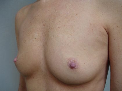 Breast Augmentation Before & After Patient #1624