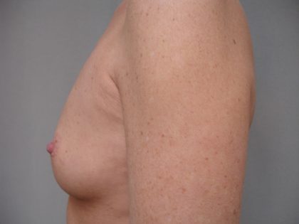 Breast Augmentation Before & After Patient #1624