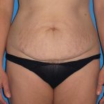 Tummy Tuck Before & After Patient #2167