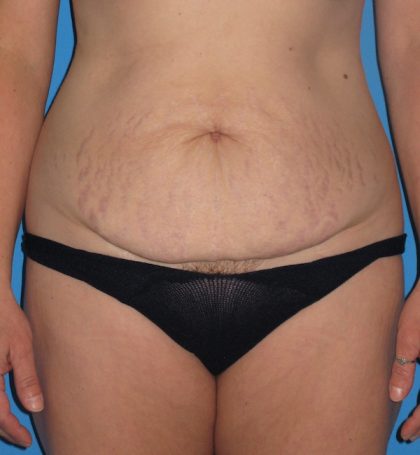 Tummy Tuck Before & After Patient #2167