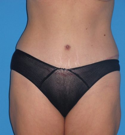 Tummy Tuck Before & After Patient #2167