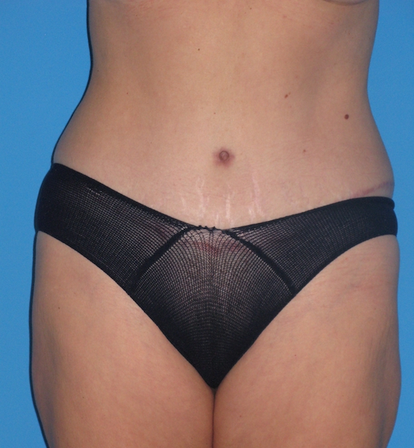 Tummy Tuck Before & After Patient #2167