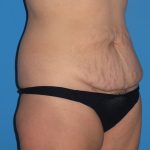 Tummy Tuck Before & After Patient #2167