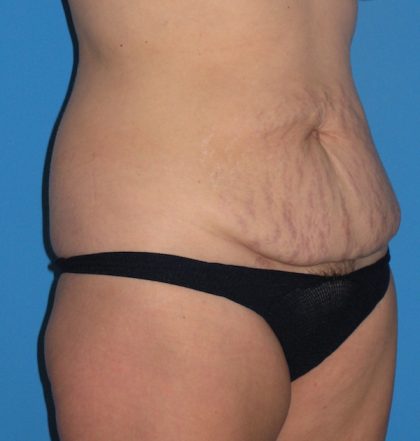 Tummy Tuck Before & After Patient #2167