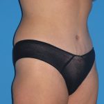 Tummy Tuck Before & After Patient #2167