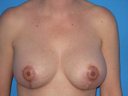 Breast Augmentation with Lift Before & After Patient #1733