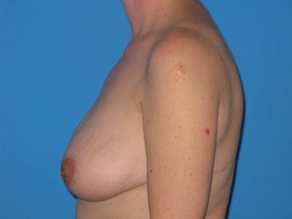 Breast Augmentation with Lift Before & After Patient #1733