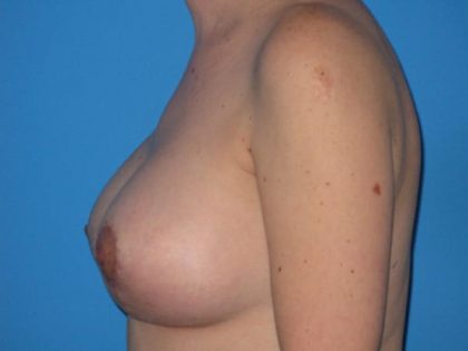 Breast Augmentation with Lift Before & After Patient #1733