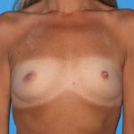 Breast Augmentation Before & After Patient #1635
