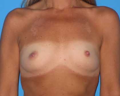 Breast Augmentation Before & After Patient #1635