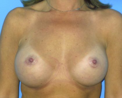 Breast Augmentation Before & After Patient #1635