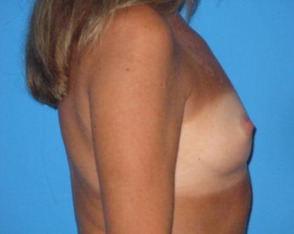 Breast Augmentation Before & After Patient #1635