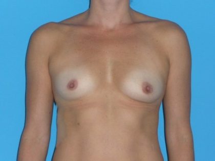 Breast Augmentation Before & After Patient #1646