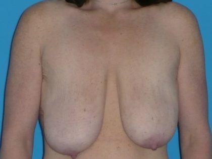Breast Reduction Before & After Patient #2024