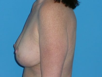 Breast Reduction Before & After Patient #2024