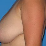 Breast Reduction Before & After Patient #2035