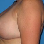 Breast Reduction Before & After Patient #2035