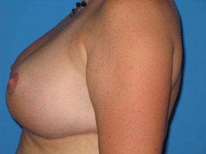 Breast Reduction Before & After Patient #2035