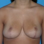 Breast Reduction Before & After Patient #2042