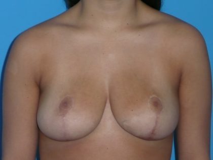 Breast Reduction Before & After Patient #2042
