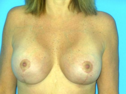 Breast Augmentation with Lift Before & After Patient #1749