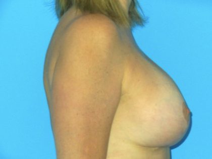 Breast Augmentation with Lift Before & After Patient #1749