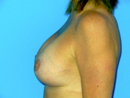 Breast Augmentation with Lift Before & After Patient #1749
