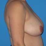 Breast Reduction Before & After Patient #2091