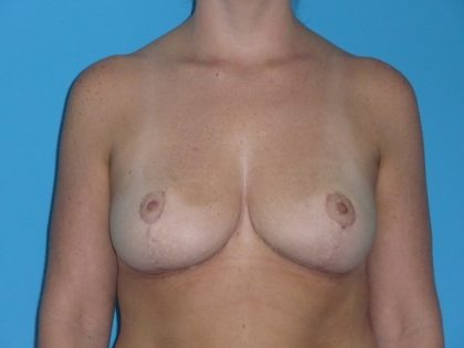 Breast Reduction Before & After Patient #2058