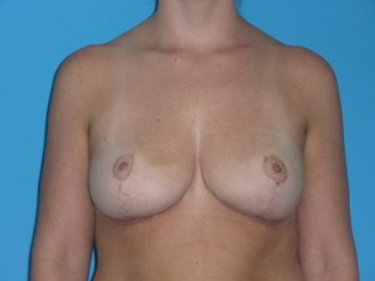 Breast Reduction Before & After Patient #2058