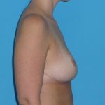 Breast Reduction Before & After Patient #2058