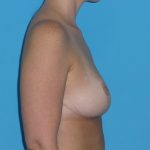 Breast Reduction Before & After Patient #2058