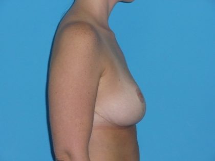 Breast Reduction Before & After Patient #2058