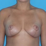 Breast Reduction Before & After Patient #2069