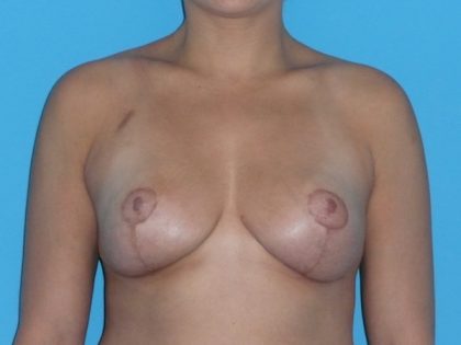 Breast Reduction Before & After Patient #2069