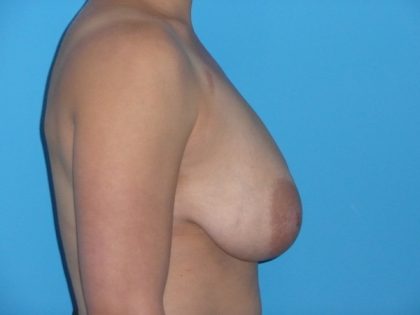 Breast Reduction Before & After Patient #2069