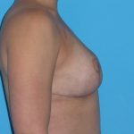 Breast Reduction Before & After Patient #2069