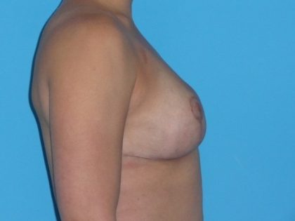 Breast Reduction Before & After Patient #2069