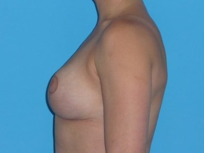 Breast Reduction Before & After Patient #2069