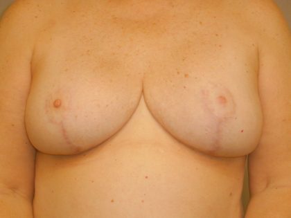 Breast Reduction Before & After Patient #2080