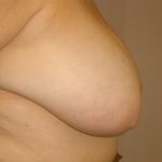 Breast Reduction Before & After Patient #2080