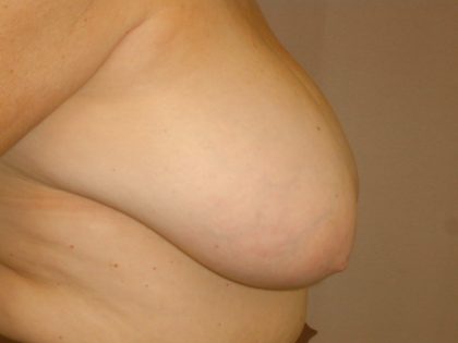 Breast Reduction Before & After Patient #2080