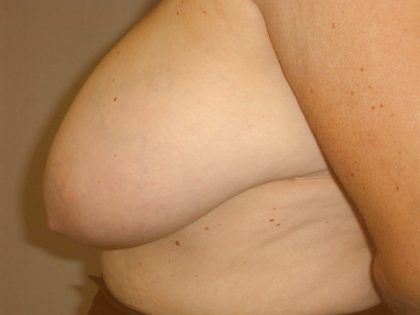 Breast Reduction Before & After Patient #2080