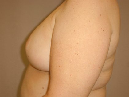 Breast Reduction Before & After Patient #2080