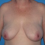 Breast Reduction Before & After Patient #2102