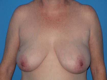 Breast Reduction Before & After Patient #2102