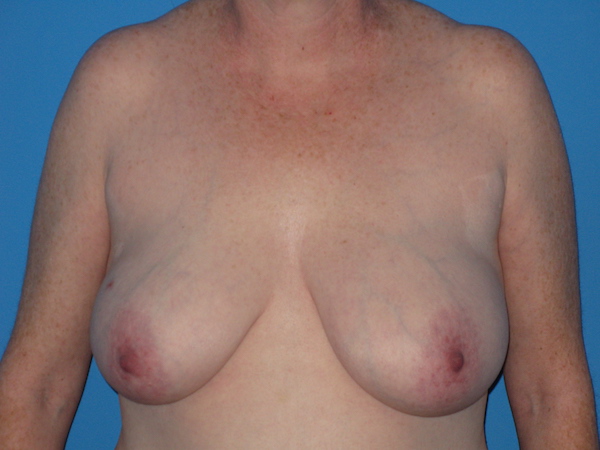 Breast Reduction Before & After Patient #2102