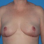 Breast Reduction Before & After Patient #2102