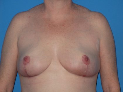 Breast Reduction Before & After Patient #2102