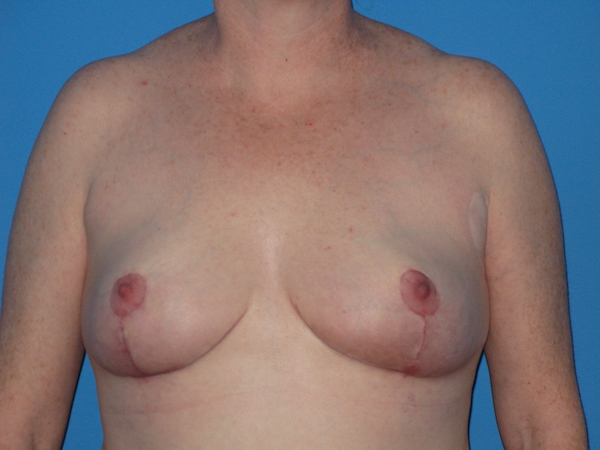Breast Reduction Before & After Patient #2102